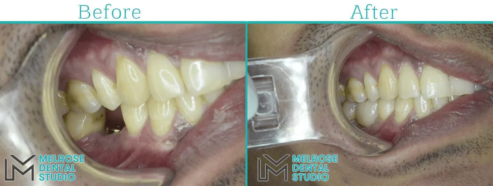 Before and after of a smile restored with Nobel Biocare dental implants, case 6